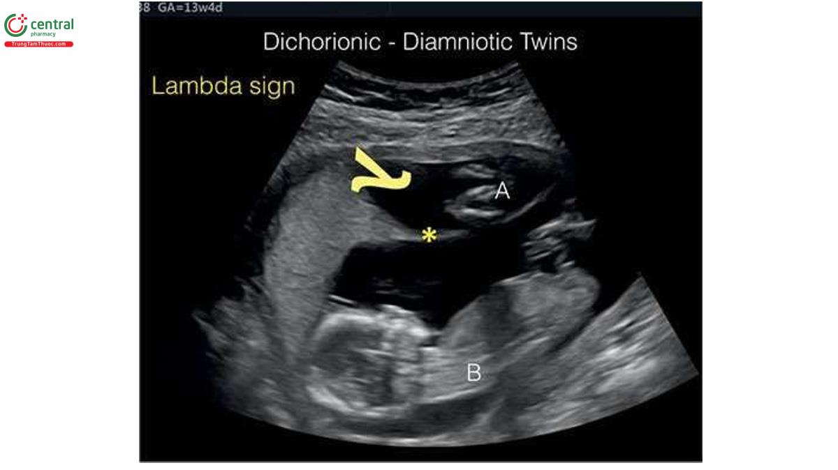 Hình 7.4: Song thai hai màng đệm- hai màng ối (A và B) lúc 13 tuần tuổi. Màng ngăn (dấu hoa thị) dày với dấu hiệu lambda (l) hoặc twin-peak ở vị trí các màng cắm vào nhau thai