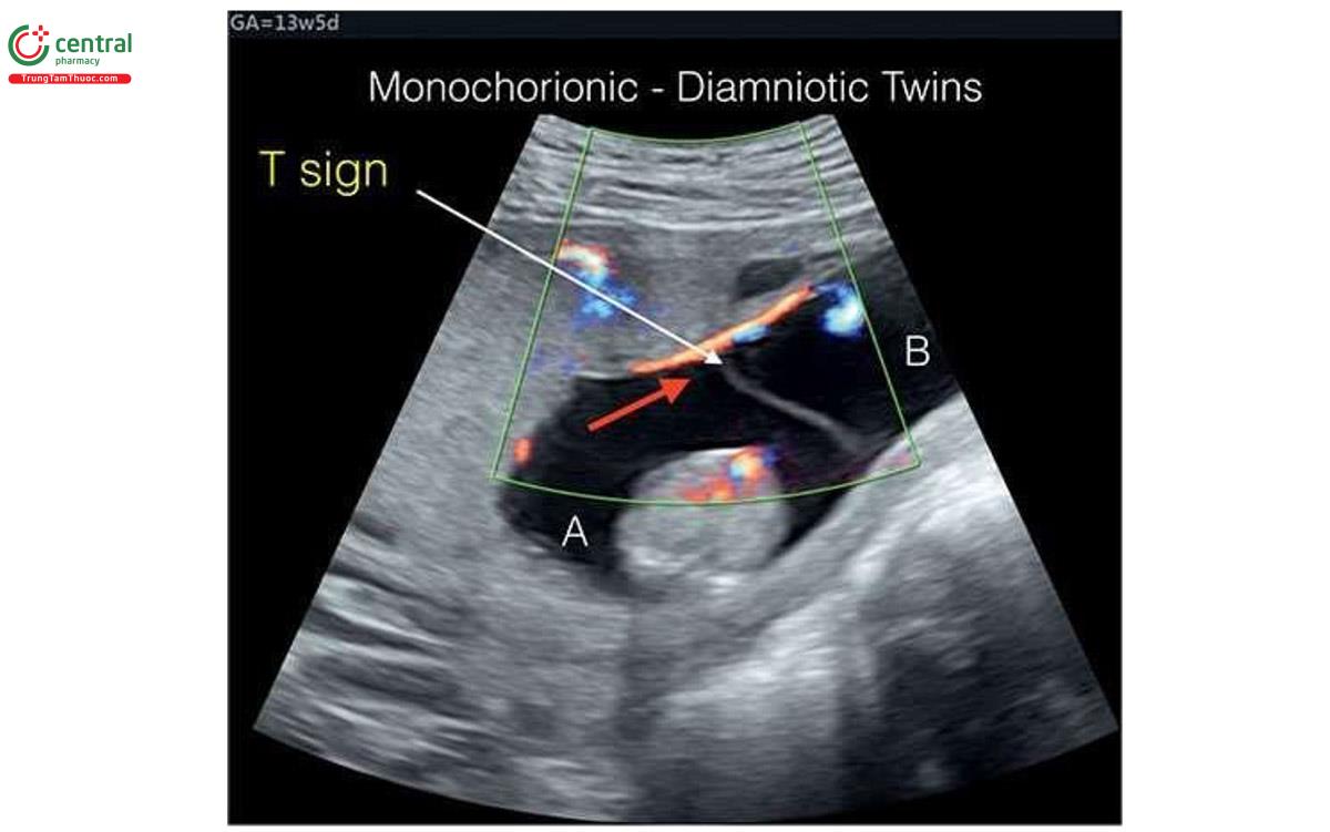 Hình 7.6: Song thai một màng đệm - hai màng ối lúc 13 tuần tuổi. Có thể thấy một màng ngăn mỏng có hình chữ T ở vị trí cắm vào nhau thai ngăn cách thai A với thai B. Trong trường hợp này, Doppler màu cho thấy một động mạch có hướng đi từ thai A đến thai B (mũi tên đỏ). Sự thông nối như vậy có ở hầu hết tất cả nhau thai một màng đệm và đôi khi có thể được thấy trên Doppler màu như cho thấy ở đây.