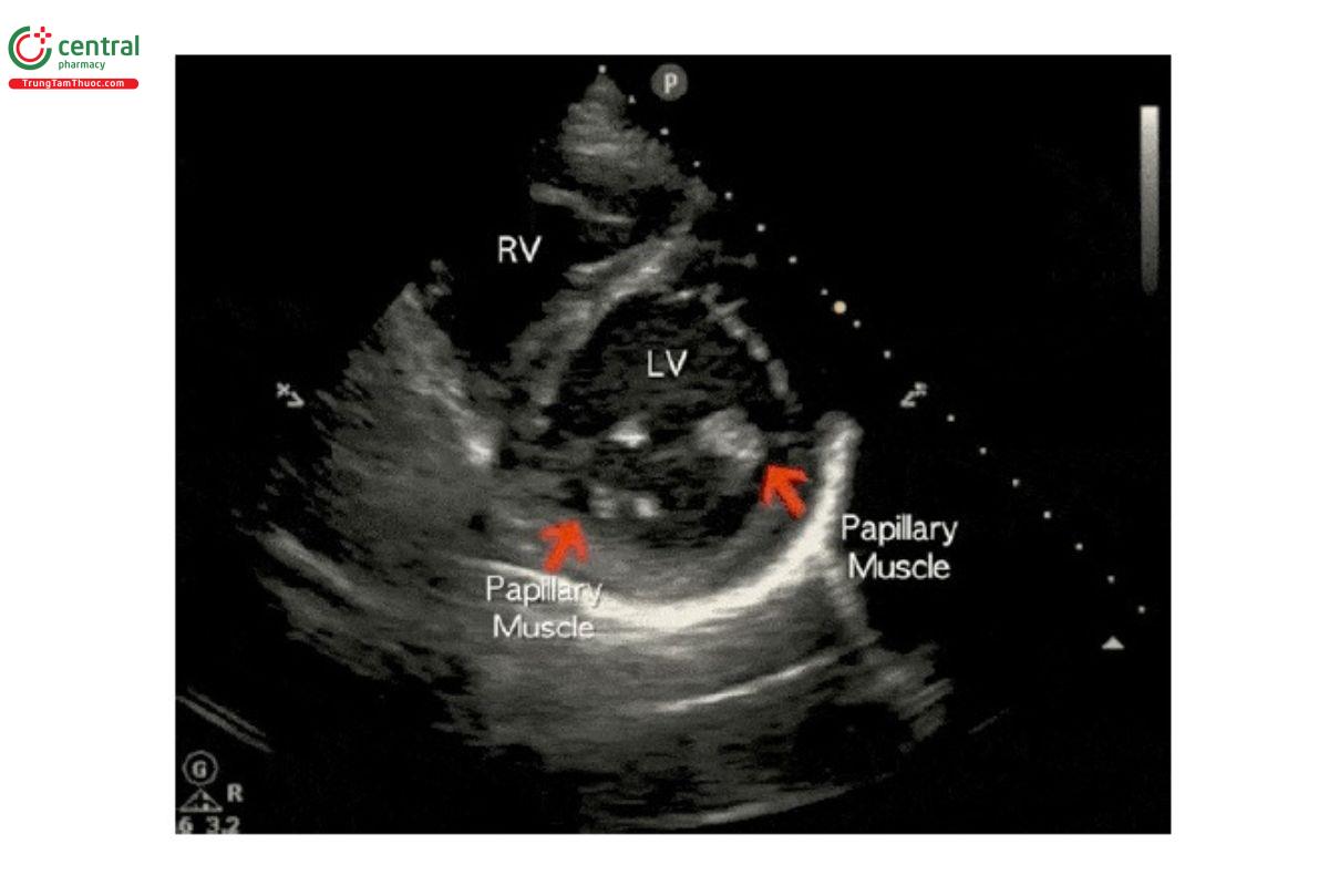 PSSA - RV: thất phải, LV: thất trái, Papillary Muscle: cơ nhú