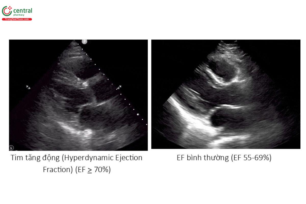 các mức độ EF