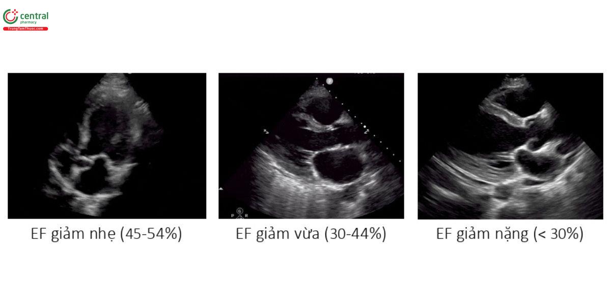 các mức độ EF