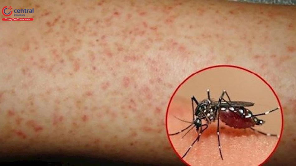 Sốt xuất huyết Dengue là gì?
