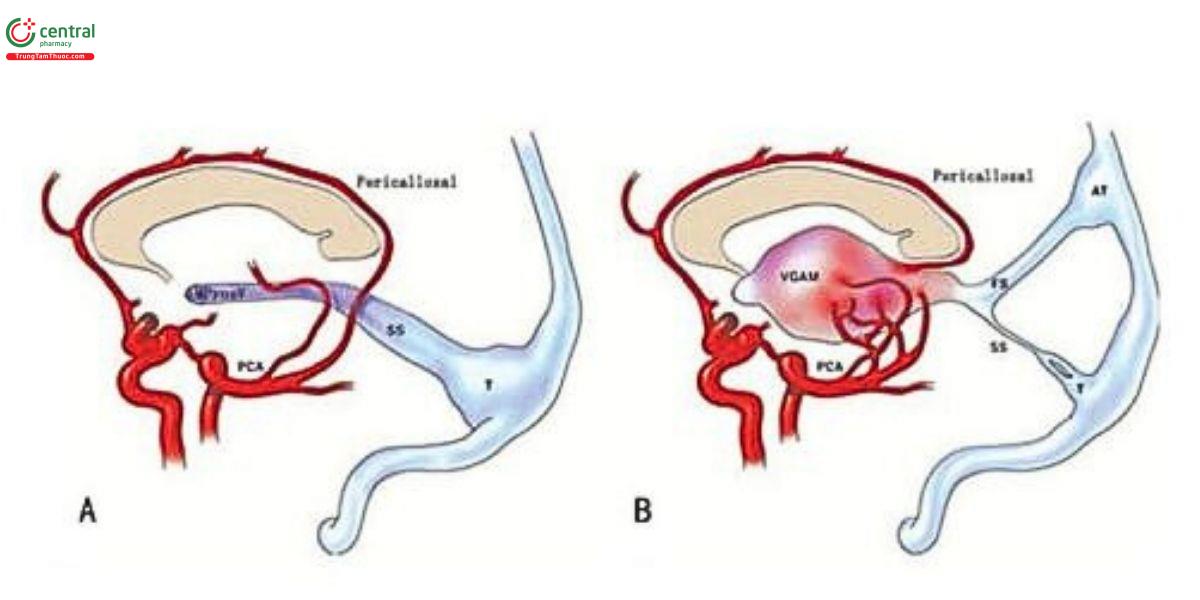 Hình 1. Sự hình thành VGAM. (A) Cấu trúc mạch máu bình thường giữa các động mạch quanh thể trai và động mạch nào sau (PCA) xuất hiện trong giai đoạn phôi thai. (B) Kết nổi động tĩnh mạch bất thường với lưu lượng cao gây giãn phình MProsV, dẫn đến hình thành VGAM. Sự kết nổi này dẫn lưu vào xoang thẳng (SS) và sau đó vào torcula (T). Ngoài ra, máu cũng có thể dẫn lưu vào xoang liểm (FS) rồi vào torcula phụ (AT) khi SS bị thiểu, kém phát triển hoặc hẹp.