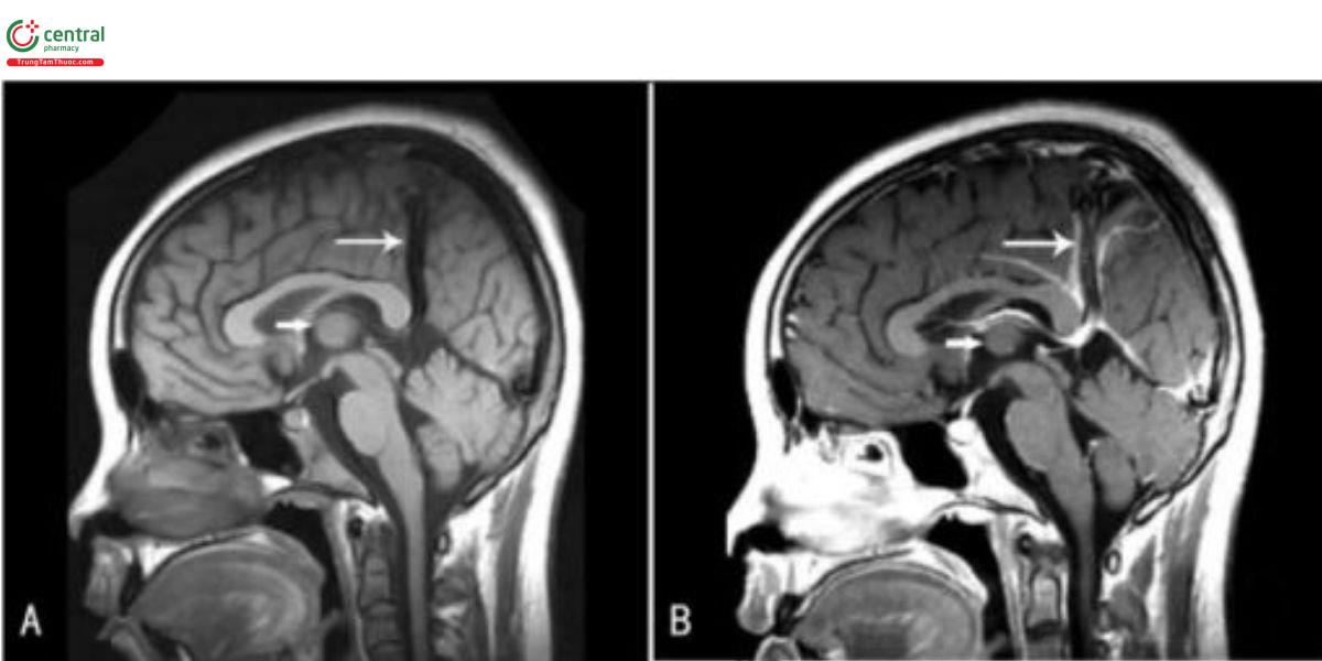 Hình 2. Hình MRI sọ não mặt phẳng dọc giữa của một bệnh nhân VGAM cho thấy MPros V giản (mùi tên ngắn) được nối với xoang liềm tồn tại (mũi tên dài), dẫn lưu vào xoang dọc trên và không có xoang thắng trên TIWI (A) và T2WI (B). MProsV: tĩnh mạch trung nào trước, VGAM: dị dạng phỉnh tĩnh mạch Galen.
