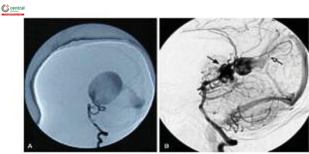Hình 3. (A) Loại thành mạch của VGAM. Chụp mạch cộng hưởng từ (MR angiography) cho thấy một AVF dẫn trực tiếp vào thành túi tĩnh mạch. Lưu ý sự dẫn lưu của dị dạng vào xoang thẳng bị hẹp; (B) Loại đám rối mạch mạc của VGAM. So với loại thành mạch, chụp mạch cộng hưởng từ của loại đám rối mạch mạc cho thấy một mạng lưới động mạch rộng như một tổ tập trung ở vùng bé quadrigeminal plate (mũi tên đóng), chảy vào dị dạng và xoang liềm nguyên thủy (mũi tên mở).