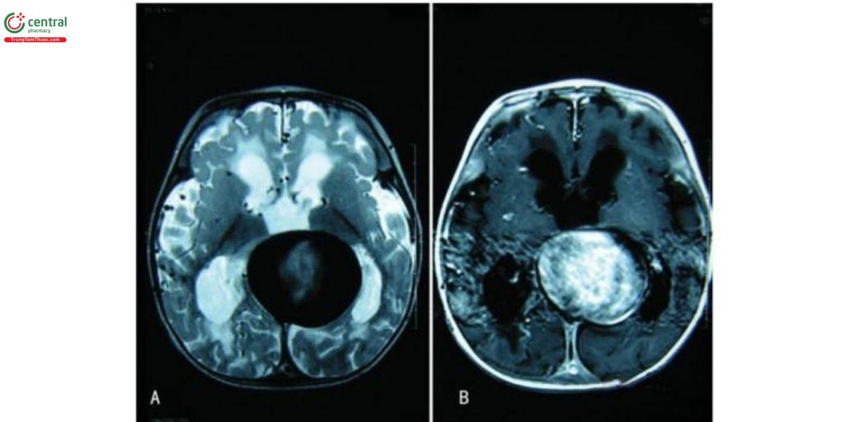 Hình 5. MRI não mặt cắt ngang của một bệnh nhân VGAM cho thấy một khối hình tròn ranh giới rõ nằm ở đường giữa trong vùng tuyển tùng, kèm theo giản thất bên và thất ba trên TIWI (A) và T2WI (B).