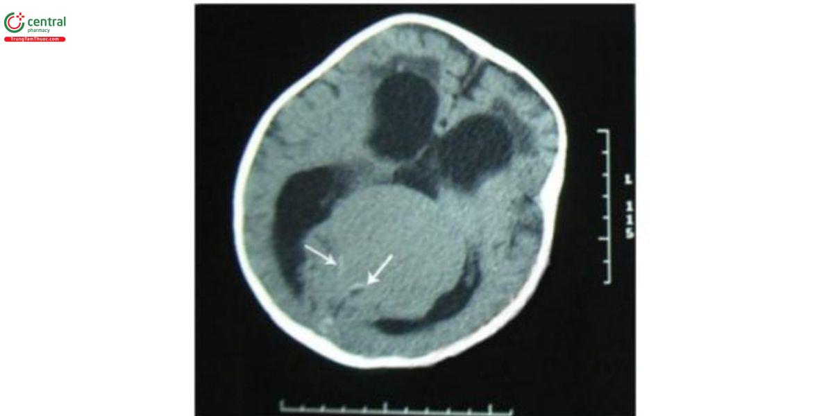 Hình 4. Chụp CT trục nào của một bệnh nhân VGAM cho thấy một khối hình cầu đồng nhất, ranh giới rõ, kèm theo giãn thất ba và thất bên và não úng thủy do chèn ép, cũng như giảm tỷ trọng chất trắng quanh thất (mũi tên).