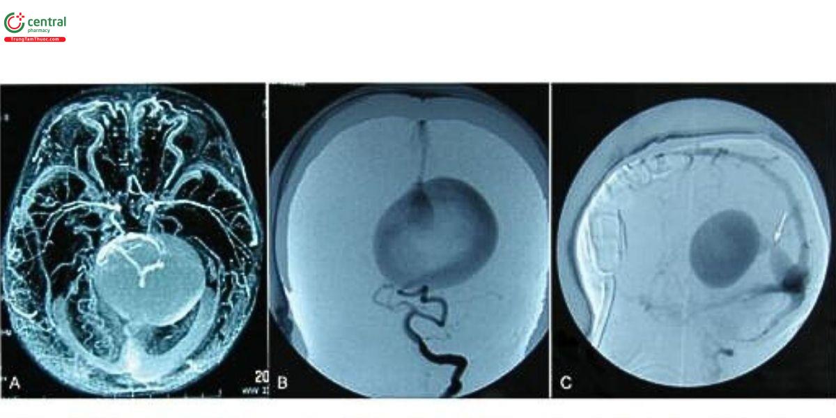 Hình 6. (A) Chụp mạch cộng hưởng từ (MR angiography) cho thấy khối phỉnh giản kèm theo một số mạch nuôi, dẫn lưu vào xoang tháng. (B) Chụp mạch động mạch đốt sống cho thấy tĩnh mạch trung nào trước giãn, dẫn lưu vào xoang thẳng, thuộc loại thành mạch của VGAM. (C) Hình bên cho thấy hẹp xoang thắng (mũi tên) dẫn hưu trực tiếp vào xoang dọc trên.