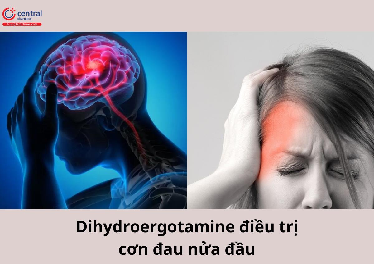 Dihydroergotamine điều trị cơn đau nửa đầu