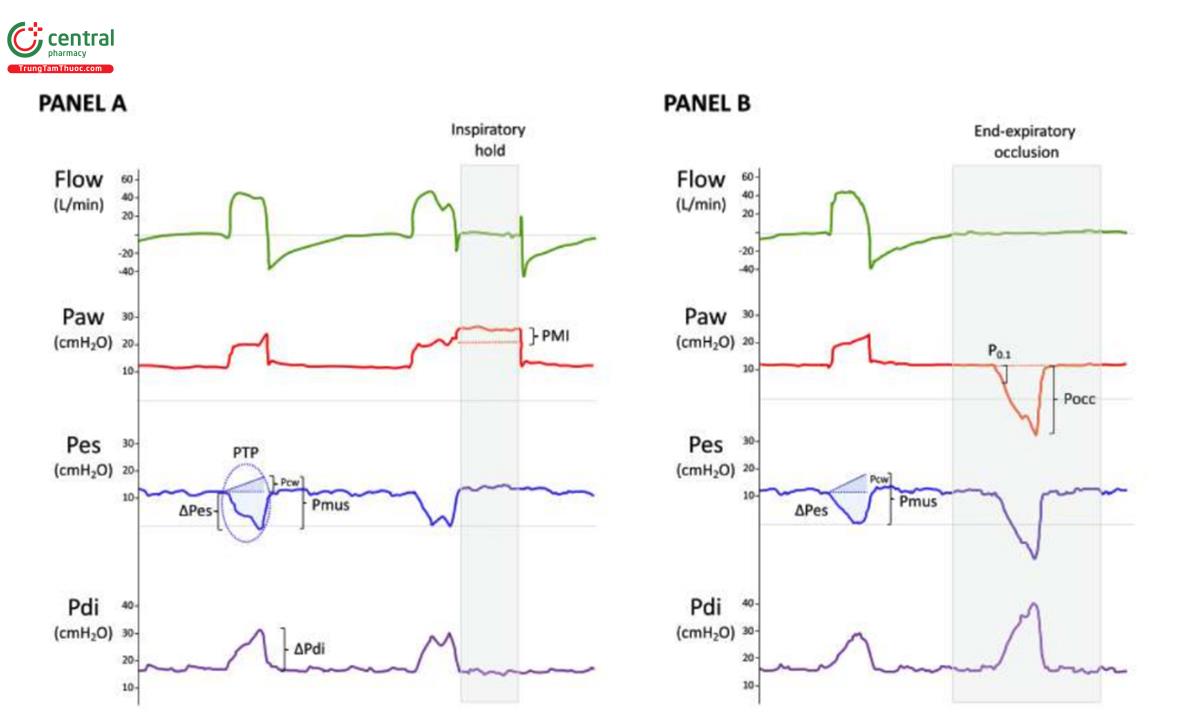 Hình 1 Theo dõi xâm lấn và không xâm lấn nỗ lực hít vào và trung tâm hô hấp. Hình 1 cho thấy đường cong đại diện từ một bệnh nhân ARDS thở máy trở lại thở tự nhiên dưới thông khí hỗ trợ áp lực (hỗ trợ áp lực, 10 сmН2О; РЕЕР 12 cmH2O; độ nhạy kích hoạt lưu lượng, 2 lít/phút). Từ trên xuống dưới: lưu lượng, áp lực đường thở [Paw], áp lực thực quản [Pes] và áp lực xuyên cơ hoành [Pdi]). Hai loại phép đo liên quan đến nỗ lực được mô tả: phép đo bắt nguồn từ áp lực thực quản và phép đo không xâm lấn. Để theo dõi xâm lấn, cần có tín hiệu áp lực thực quản. Trong bảng A, dao dộng áp lực thực quản (△Pes), dại diện cho cường độ của nỗ lực hít vào, là -13,8 cmH2O trong chu kỳ dại diện. Áp lực cơ (Pmus) được tạo ra bởi tất cả các cơ hô hấp là 19,7 cmH2O, được tính bằng chênh lệch giữa áp lực đàn hồi thành ngực (Pcw = 5,9 cmH2O) và ∆Pes trong thì hít vào. Pew là tích số của thể tích khí lưu thông (V₁ = 578 ml trong chu kỳ này) và độ đàn hồi của thành ngực (Ecw = 10,2 cmH2O/L). Tích phân của Pmus trong thì hít vào tương ứng với tích số áp lực-thời gian thực quản hoặc PTP là 10 cmH2O*s trong cùng một chu kỳ. Khi có tín hiệu áp lực dạ dày (Pga) (không thể hiện trong hình), sự chênh lệch giữa Pga và Pes thể hiện áp lực xuyên cơ hoành (Pdi là 15,1 cmH2O trong cùng một chu kỳ). Để theo dõi nỗ lực không xâm lấn, cần có các thao tác giữ thì hít vào (Bảng A) và tắc cuối thì thở ra (B). Trong quá trình giữ thì hít vào, (tức là lưu lượng bằng 0), quan sát thấy Paw cao nguyên lớn hơn áp lực hít vào tối đa, điều này giải thích cho nỗ lực hít vào. Sự khác biệt giữa áp lực cao nguyên và áp lực hít vào cao nhất được gọi là chỉ số áp lực cơ (pressure muscle index - PMI) và tương quan với cường độ nỗ lực (trong ví dụ này, PMI = 5,2 cmH2O). Cần lưu ý rằng việc kích hoạt các cơ thở ra trong quá trình giữ thì hít vào không cho phép đo Paw cao nguyên một cách đáng tin cậy. Mặt khác, trong quá trình tắc nghẽn cuối thì thở ra, có thể thu được hai biến số từ tín hiệu áp lực đường thở: Po.1, là áp lực âm được đo trong 100 ms tắc nghẽn đầu tiên (trong chu kỳ này, – 3 cmH2O); và áp lực tắc (occlusion pressure - Pocc), được định nghĩa là sự dao động của áp lực đường thở được tạo ra bởi nỗ lực của cơ hô hấp khi đường thở bị tắc trong thời gian ngắn (trong chu kỳ đại diện, – 24,8 cmH2O). Pocc cho phép ước tính áp lực cơ (với công thức Pmus = 0,75 x Pocc). Như vậy, Pmus ước tính là 18,6 cmH2O. Giá trị Pmus này phù hợp với giá trị trung bình (18,6 cmH2O) giữa các giá trị Pmus được đo trực tiếp bằng ∆Pes và Pcw trong bảng A và B (lần lượt là 19,7 và 17,5 cmH2O). Xin lưu ý rằng các giá trị của △Pes và △Paw tương tự nhau trong quá trình kiểm tra tắc nghẽn cuối thì thở ra.