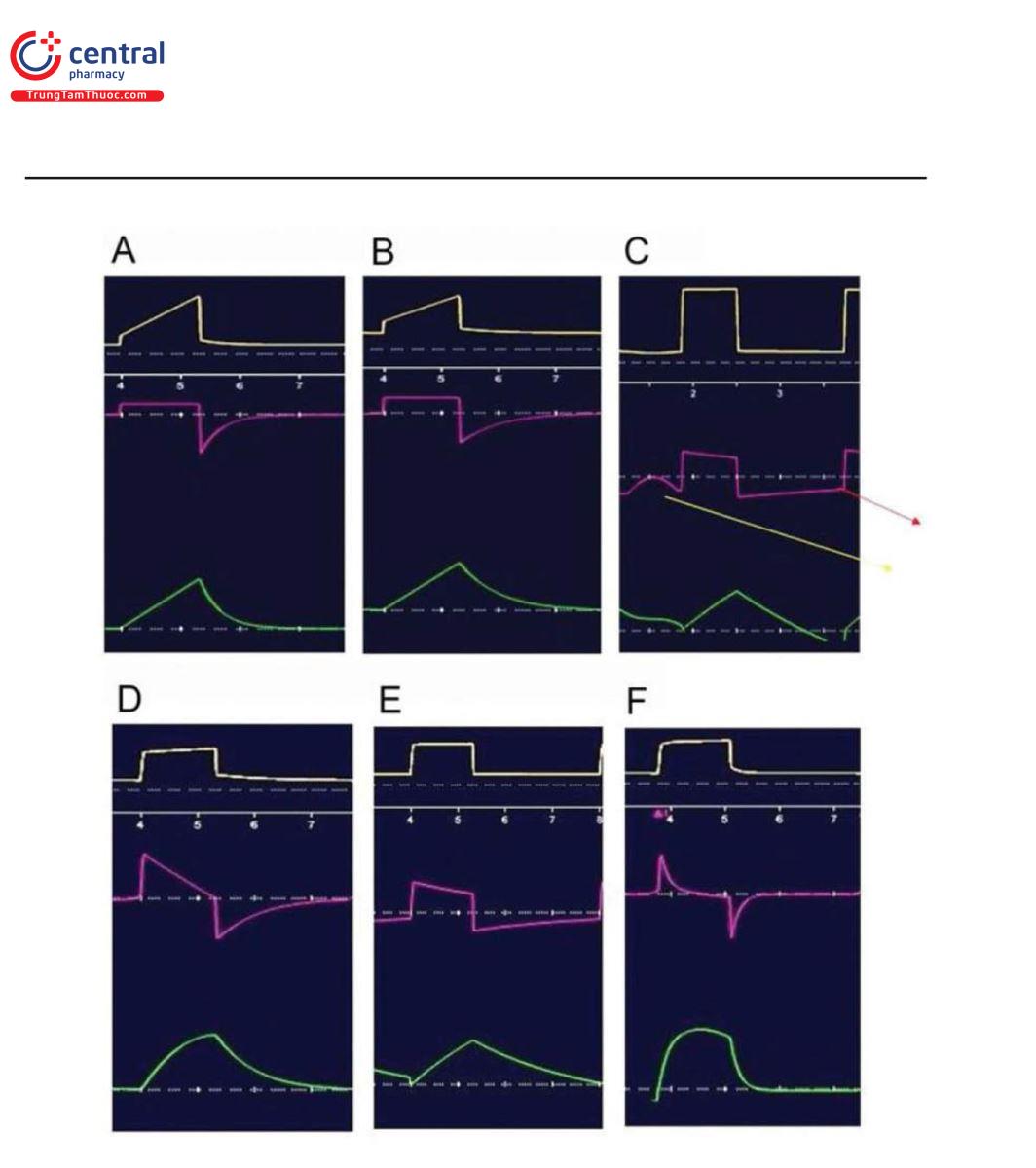 Hình 4 Chế độ kiểm soát thể tích với dạng sóng lưu lượng vuông (không đổi) trong các tình huống lâm sàng khác nhau (A–C) và chế độ kiểm soát áp lực hiển thị hình dạng lưu lượng khác nhau trong các tình huống lâm sàng khác nhau (D–F). (A) ARDS, (B) bình thường, (C) COPD cho thấy nỗ lực bị bỏ lỡ (mũi tên màu vàng) và PEEP tự động (mũi tên đỏ), (D) sức cản và độ giãn nở bình thường, (E) COPD với sức cản và độ giãn nở cao hơn, và (F) ARDS có sức cản bình thường và độ giãn nở thấp. Đường cong màu vàng phía trên là áp lực đường thở tính bằng cmH2O, đường cong màu hồng ở giữa là lưu lượng tính bằng L/phút và đường cong màu xanh lá cây phía dưới là thể tích khí lưu thông tính bằng mL.
