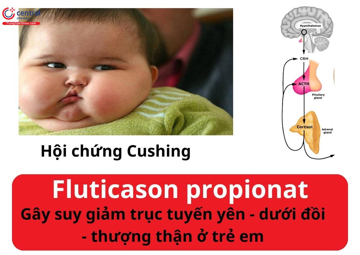 Trẻ em dễ bị suy giảm trục tuyến yên - dưới đồi - thượng thận và mắc hội chứng Cushing khi dùng fluticason propionat