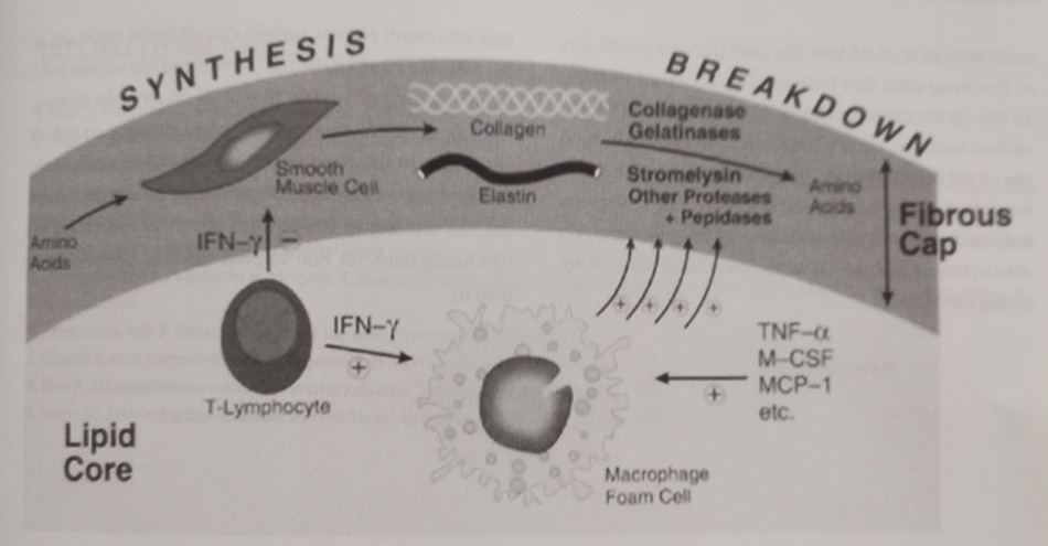 Hình 6.19. Chiều dày của lớp vỏ xơ phụ thuộc sự cân bằng giữa tổng hợp và giáng hoá các protein hệ thống ngoại bào của các tế bào cơ trơn (SMCs). Tiến trình này chịu ảnh hưởng bởi các tế bào viêm.