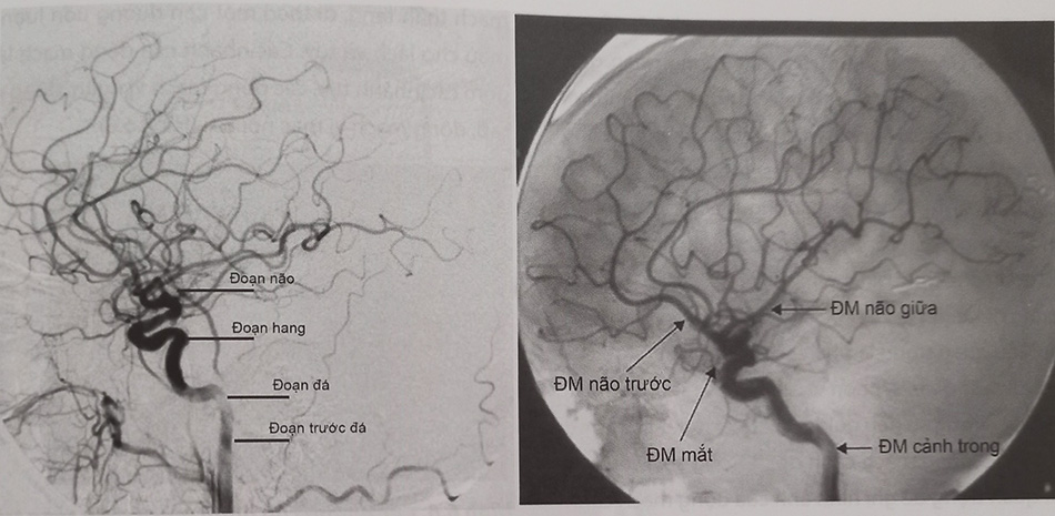 Hình 6.4. Hình ảnh chụp nghiêng bên của động mạch cảnh trong và các nhánh của nó