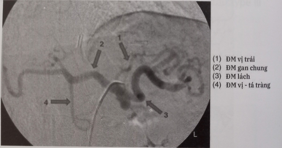Hình 6.6. Các nhánh của động mạch thân tạng trên phim chụp DSA