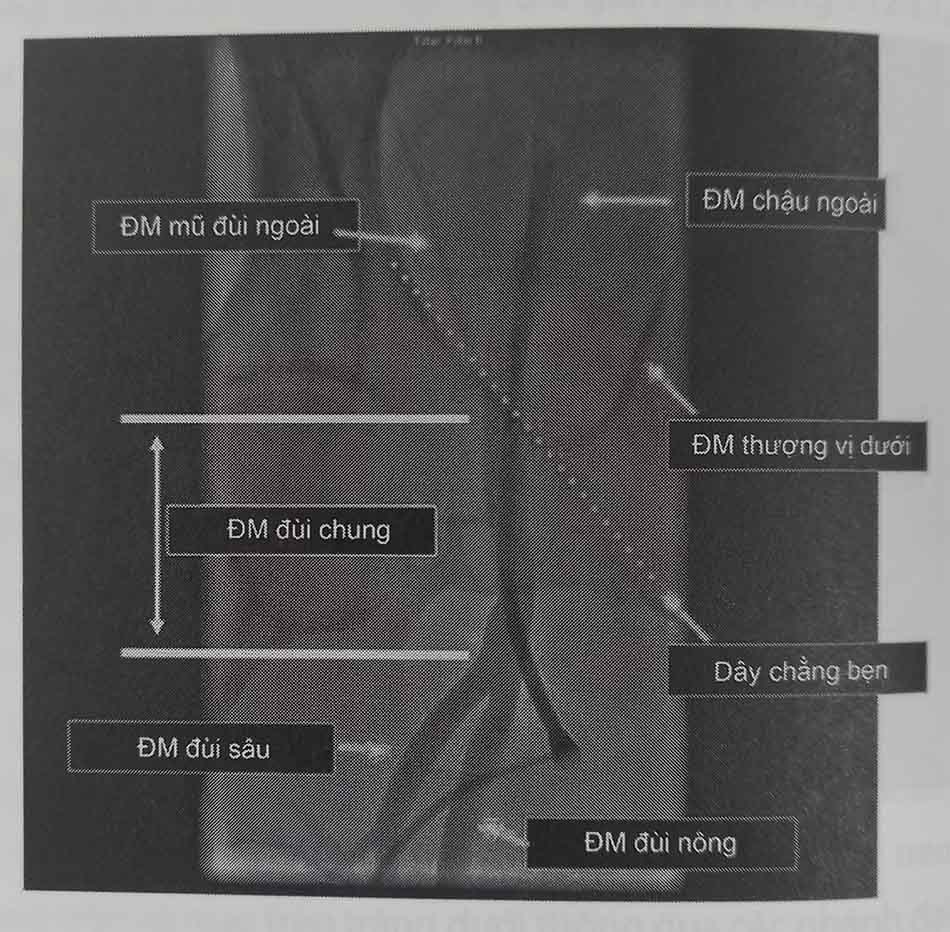 Hình 6.9. Mốc giải phẫu của động mạch đùi chung trên