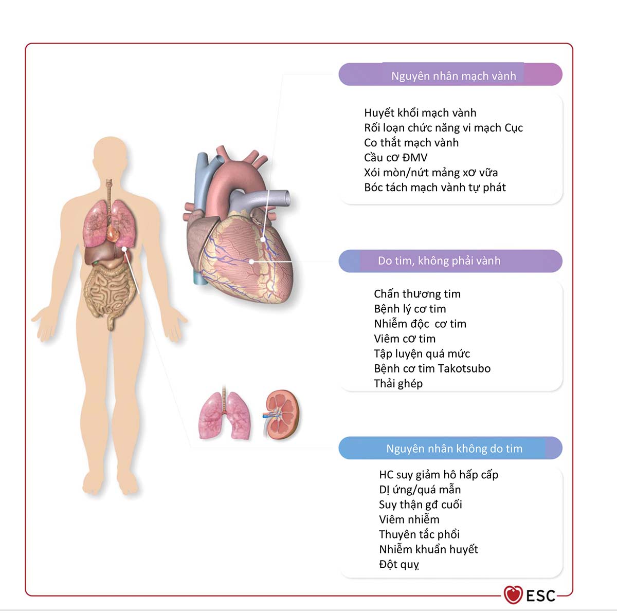 Hình 15 Các nguyên nhân cơ bản gây nhồi máu cơ tim không tắc nghẽn động mạch vành