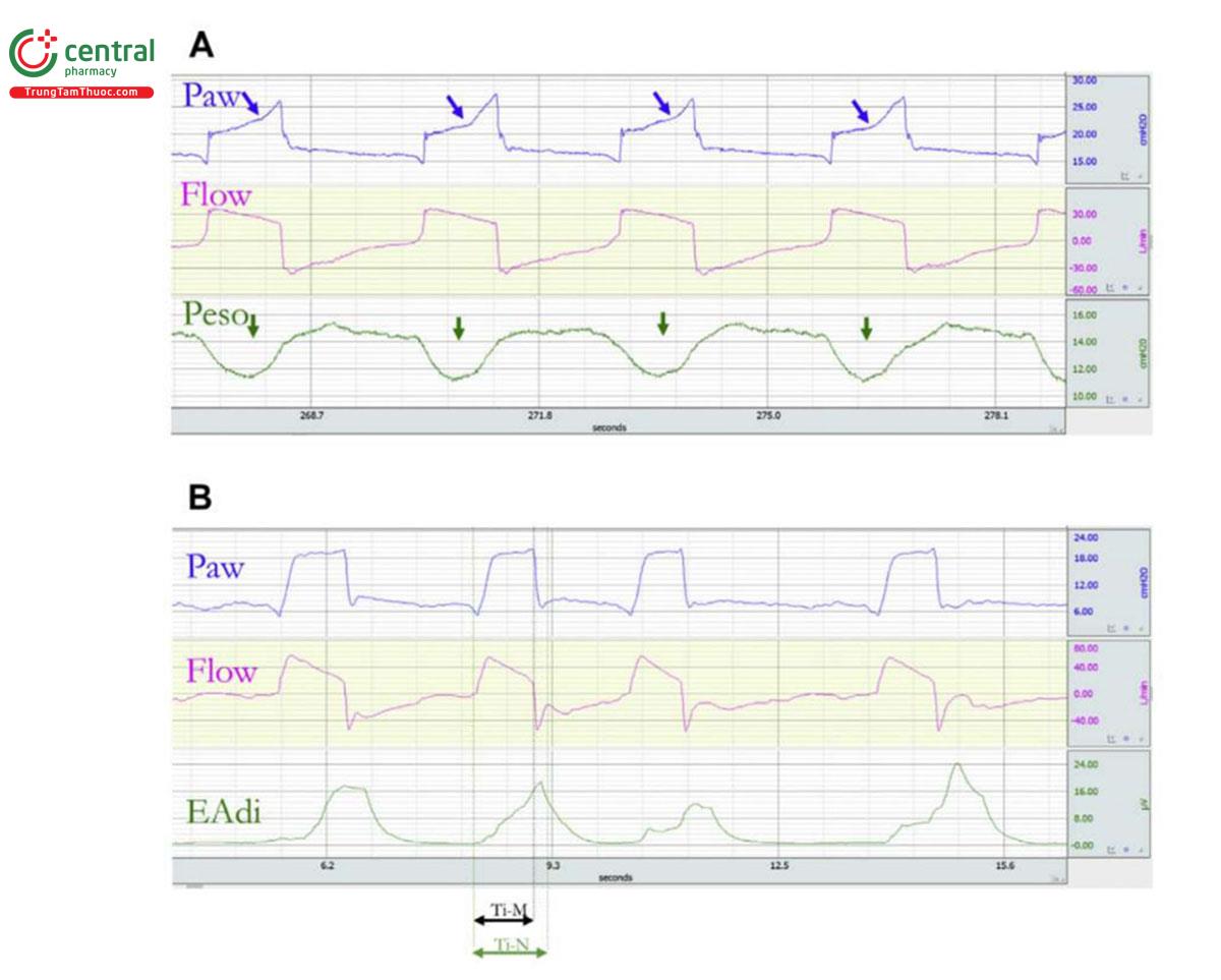 Hình 2. (A) Ví dụ về theo dõi tình trạng thiểu lưu lượng tương đối: máy thở ở chế độ trợ giúp kiểm soát thể tích với lưu lượng giảm tốc. Lưu lượng do máy thở cung cấp không đáp ứng được nhu cầu của bệnh nhân. Trong giai đoạn hít vào, có độ lệch lõm của Paw (mũi tên màu xanh), trong khi Peso cho thấy độ lệch âm cho thấy nỗ lực của bệnh nhân (mũi tên màu xanh lá cây). (B) Ví dụ về chu kỳ ngắn trong thông khí hỗ trợ áp lực. Thời gian hít vào thần kinh của bệnh nhân (Ti-N từ khi kích hoạt đến thời điểm EAdi giảm xuống 70% EAdi tối đa) dài hơn nhịp thở thực tế do máy thở cung cấp (Ti-M). EAdi, hoạt động điện của cơ hoành; Peso, áp lực thực quản; Ti-M, thời gian bơm phồng của máy; Ti-N, thời gian hít vào thần kinh.