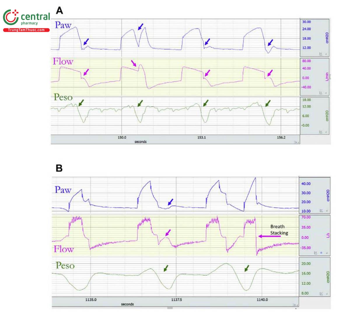 Hình 3. (A) Ví dụ về kích hoạt ngược trong trợ giúp kiểm soát thể tích với lưu lượng giảm tốc. Mỗi lần bơm phồng được kích hoạt theo thời gian (điều khiển bằng máy); ở giữa (nhịp thở 2) hoặc ở cuối giai đoạn hít vào (thở 1, 3 và 4), xảy ra độ lệch âm của Peso (kích hoạt ngược, mũi tên màu xanh lá cây) dẫn đến độ lệch âm của Paw ( mũi tên màu xanh) và tăng lưu lượng trong giai đoạn bơm phồng của máy hoặc làm chậm nó trong giai đoạn thở ra của máy (mũi tên màu hồng). (B) Ví dụ về kích hoạt ngược và điều chỉnh nhịp thở trong trợ giúp kiểm soát thể tích. Nhịp thở đầu tiên được kích hoạt bởi bệnh nhân, nhịp thở thứ hai được kích hoạt bằng máy và tiếp theo là kích hoạt ngược (mũi tên màu xanh lá cây đầu tiên) bắt đầu ở giai đoạn cuối của quá trình bơm khí vào máy và tiếp tục trong giai đoạn đầu của quả trình thở ra bằng máy (dẫn đến độ lệch dương của dòng khí [mũi tên hồng] không tạo ra nhịp thở mới): nhịp thở thứ ba được kích hoạt bằng máy, tiếp theo là kích hoạt ngược (mũi tên màu xanh lá cây thứ hai). Việc kích hoạt ngược lại này dẫn đến nhịp thở thứ tư trước khi thở ra hoàn toàn nhịp thở trước đó (xếp chồng nhịp thở). EAdi, hoạt động điện của cơ hoành; Ti-M, thời gian bơm phồng của máy; Ti-N, thời gian hít vào thần kinh.