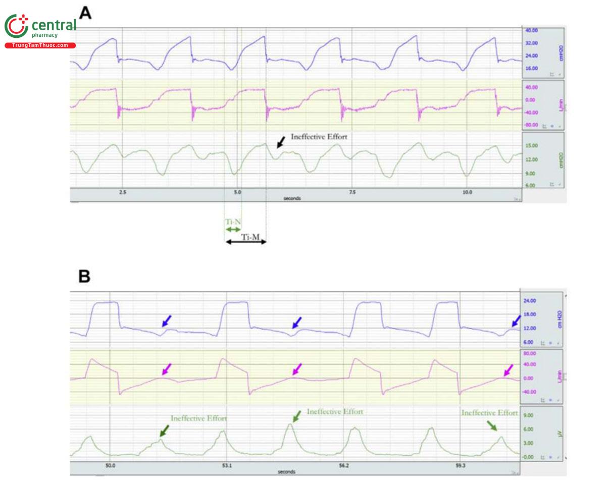 Hình 4. (A) Ví dụ về chu kỳ bị trì hoãn (tiếp theo là nỗ lực không hiệu quả) trong trợ giúp-kiểm soát thể tích. Nhịp thở được cung cấp bởi máy thở (Ti-M) dài hơn nỗ lực thực tế của bệnh nhân (Tì-N từ khi bắt đầu nỗ lực đến thời điểm Peso giảm xuống 70% độ lệch Peso tối đa). Mỗi nhịp thở do máy thở cung cấp được theo sau bởi một nỗ lực không hiệu quả trong giai đoạn đầu của quá trình thở ra của máy. (B) Ví dụ về việc theo dõi với nỗ lực không hiệu quả: Máy thở ở chế độ PSV. Ba nỗ lực của bệnh nhân (mũi tên xanh) không gây ra hiện tượng bơm phồng máy. Tại thời điểm lãng phí nỗ lực, có thể nhận thấy độ lệch dương trong đường theo dõi đường thở (mũi tên màu hồng) và độ lệch âm ở Paw (mũi tên màu xanh). Ti-M, thời gian bơm phồng của máy; Ti-N, thời gian hít vào thần kinh.