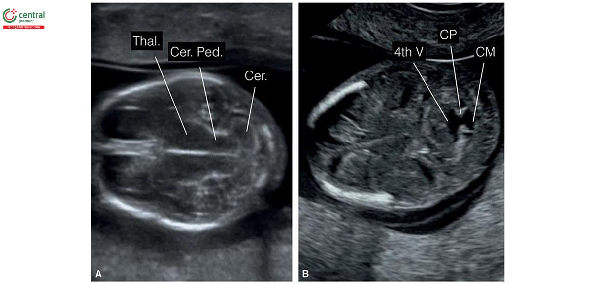 Hình 8.11: Mặt cắt ngang đầu thai nhi 13 tuần tuổi thu được ở mức hố sau (thấp hơn mặt cắt A và B ở Hình 8.10). A: Ở mức tiểu não đang phát triển (Cer.) và cuống đại não (Cer. Ped.). Lưu ý, đồi thị (Thal.) ở vị trí phía trước hơn. B: Mặt cắt chếch, thấp hơn một chút cho thấy não thất bốn mở (4th V) thông với bể lớn tương lai (CM). Cũng có thể thấy đám rối mạch mạc não thất bốn hồi âm dày (CP).