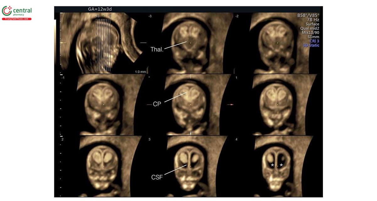 Hình 8.13: Mặt cắt vành trước của đầu thai nhi 12 tuần tuổi thu được từ khối 3D và được hiển thị ở chế độ cắt lớp. Hố sau nằm ngoài phạm vi hiển thị của chế độ cắt lớp và do đó không nhìn thấy. Lưu ý, đồi thị (Thal.), đám rối mạch mạc (CP), và dịch não tủy (CSF) ở phần trước của não thất bên (dấu hoa thị).