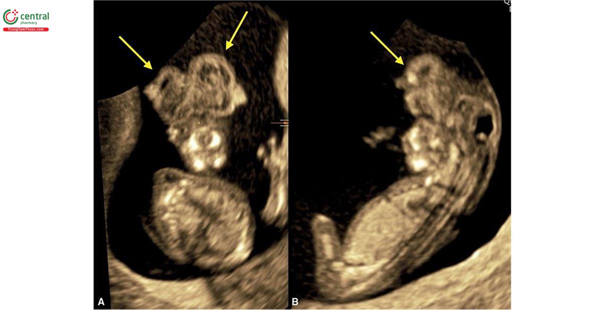 Hình 8.15: Mặt cắt vành (A) và dọc (B) của thai nhi 11 tuần tuổi bị anencephaly / exencephaly. Não bị thay thế bằng mô não vô định hình (mũi tên) và không có vòm sọ bên trên. Hình dạng của mô não vô định hình trong mặt cắt vành ở A giống tai của chuột Mickey và được gọi là dấu hiệu "Chuột Mickey". Lưu ý, ở B, không có trán và mô não nhô ra (mũi tên).