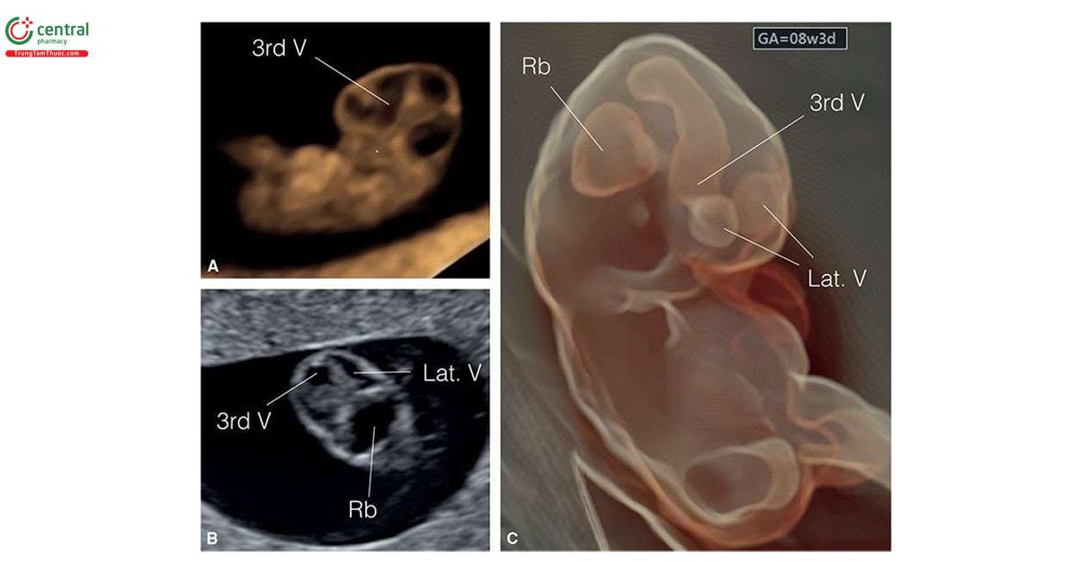 Hình 8.2: (A, B và C) Hình ảnh siêu âm 3D của phôi thai 8 tuần tuổi cho thấy sự phát triển sớm của não bộ. A: Mặt cắt dọc giữa thai nhi ở chế độ bề mặt (surface mode). B: Mặt cắt vành của đầu thai nhi thu được từ chế độ hiển thị đa mặt cắt (multiplanar display). C: Hình ảnh thai nhi được dựng lại ở chế độ Silhouette®. Lưu ý, các mối quan hệ giải phẫu của não thất bên (Lat. V), não thất ba (3rd V), và não thất bốn (Rb).