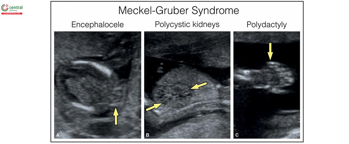 Hình 8.21: Hội chứng Meckel - Gruber ở thai nhi 12 tuần tuổi. Lưu ý, thoát vị não- màng não vùng chẩm ở A (mũi tên), thận đa nang lớn ở B (mũi tên) và thừa ngón ở C (mũi tên). Khi phát hiện thoát vị não-màng não vùng chẩm trong quý 1 nên kiểm tra kĩ lưỡng thận và các chi của thai nhi hơn để tìm kiếm các bất thường liên quan gợi ý hội chứng Meckel-Gruber.