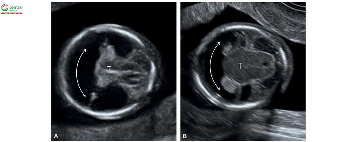 Hình 8.25: Mặt cắt ngang đầu ở 2 thai nhi (A và B) với não thất duy nhất thể không phân thùy tương ứng lúc 12 và 13 tuần tuổi. Lưu ý, não thất duy nhất hình lưỡi liềm (mũi tên hai đầu), đồi thị hợp nhất (T) và không có liềm não.