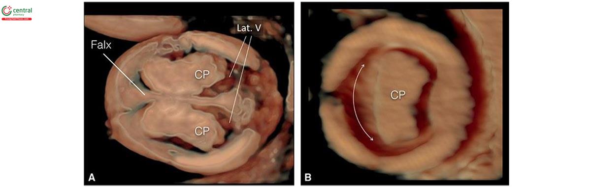 Hình 8.29: Siêu âm 3D ở chế độ bề mặt của mặt cắt ngang đầu ở thai nhi 13 tuần tuổi bình thường (A) và thai nhi có não thất duy nhất thể không phân thùy (B). Lưu ý, hình dạng bình thường của các đám rối mạch mạc (CP) ở A, ngăn cách bởi liềm não (Falx). Ở thai nhi có não trước không phân chia (B), CP hợp nhất, không có liềm não và chỉ thấy một não thất duy nhất (mũi tên hai đầu). Lat. V, não thất bên.