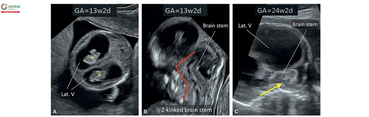 Hình 8.35: Thai này được giới thiệu đến lúc 13 tuần tuổi với tiền sử 2 thai nhi tử vong trước đó do não úng thủy nặng (severe hydrocephaly) và hội chứng Walker-Warburg. A: Mặt cắt ngang đầu thai nhi 13 tuần tuổi, cho thấy dãn não thất bên (Lat. V) và các đám rối mạch mạc nhỏ (dấu hoa thị). Mặt cắt dọc của hố sau (B) lúc 13 tuần tuổi cho thấy thân não gấp khúc hình chữ Z điển hình (đường màu đỏ), đặc trưng của hội chứng Walker-Warburg. C: Mặt cắt dọc giữa của đầu lúc 24 tuần tuổi, cho thấy dãn não thất bên nặng (Lat. V) và thân não gấp khúc (mũi tên).