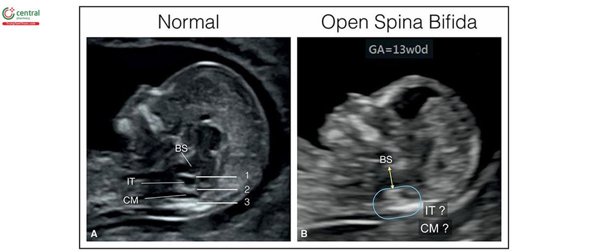 Hình 8.41: Mặt cắt dọc giữa đầu, với siêu âm qua thành bụng lúc 13 tuần tuổi ở thai nhi bình thường (A) và thai nhi bị tật chẻ đôi đốt sống thể hở (B). Ở thai nhi bình thường (A), thân não (BS) mỏng và phía sau có dịch não tủy trong não thất bốn được gọi là khoảng sáng nội sọ (IT) và trong bể lớn (CM). Thường có thể thấy 3 đường hồi âm dày ở hố sau thai nhi bình thường: đường 1 - đường viền sau của thân não; đường 2 - đám rối mạch mạc của não thất bốn; và đường 3 - xương chẩm. Trong tật chẻ đôi đốt sống thể hở (B), dịch não tủy rò rỉ ra ngoài qua khiếm khuyết và dẫn đến các thay đổi nội sọ, có thể thấy ở mặt cắt dọc giữa. Các thay đổi ở tật chẻ đôi đốt sống thể hở (B) bao gồm thân não (BS) dày và dịch chuyển ra sau (mũi tên hai đầu) (xem hình 8.42 và 8.43), giảm hoặc không có dịch trong khoảng sáng nội sọ (IT?), và bể lớn (CM?) (hình tròn) và không có 3 đường giải phẫu như được thấy ở giải phẫu bình thường (A). Cũng lưu ý, trán phẳng ở thai nhi B, dẫn đến góc trán-hàm trên nhỏ (xem Chương 9 và Hình 9.18).