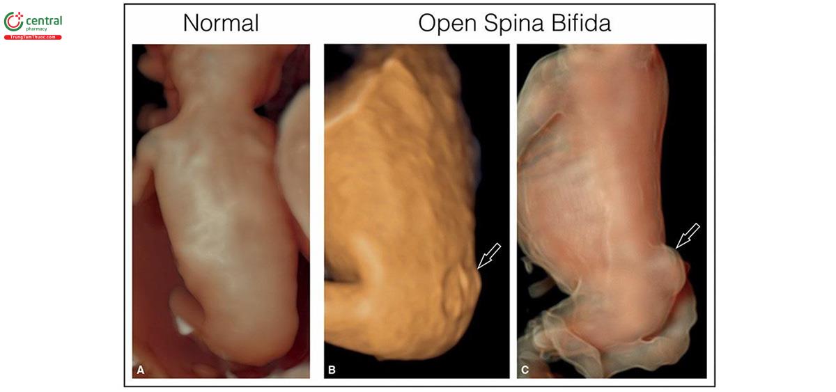 Hình 8.45: Siêu âm 3D ở chế độ bề mặt của một thai nhi bình thường (A) và 2 thai nhi bị tật chẻ đôi đốt sống thể hở như là thoát vị tủy-màng tủy (myelomeningocele) (B và C) lúc 13 tuần tuổi. Lưu ý ở B và C, thấy rõ tật chẻ đôi đốt sống ở vùng thắt lưng- cùng dưới (mũi tên). Hình ảnh siêu âm 2D tương ứng của thai nhi C được cho thấy ở Hình 8.33B.