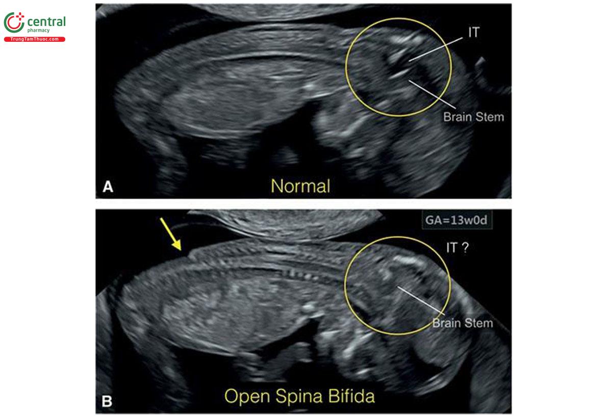 Hình 8.46: Mặt cắt dọc giữa lưng ở phía trước ở thai nhi bình thường (A) và thai nhi bị tật chẻ đôi đốt sống thể hở như là tật nứt tủy (myeloschisis) (B) lúc 13 tuần tuổi. Lưu ý, ở B khó thấy trực tiếp khiếm khuyết cột sống ở vùng thắt lưng-cùng dưới (mũi tên). Tuy nhiên, lưu ý, các thay đổi ở hố sau (hình tròn) ở thai nhi B khi so sánh với thai nhi A. Ở A, thấy khoảng sáng nội sọ (IT) và thân não mỏng (BS) so với không có dịch (IT?) và BS dày, bị chèn ép ở thai nhi có khiếm khuyết cột sống (B). Thai nhi này cũng được cho thấy ở Hình 8.47.