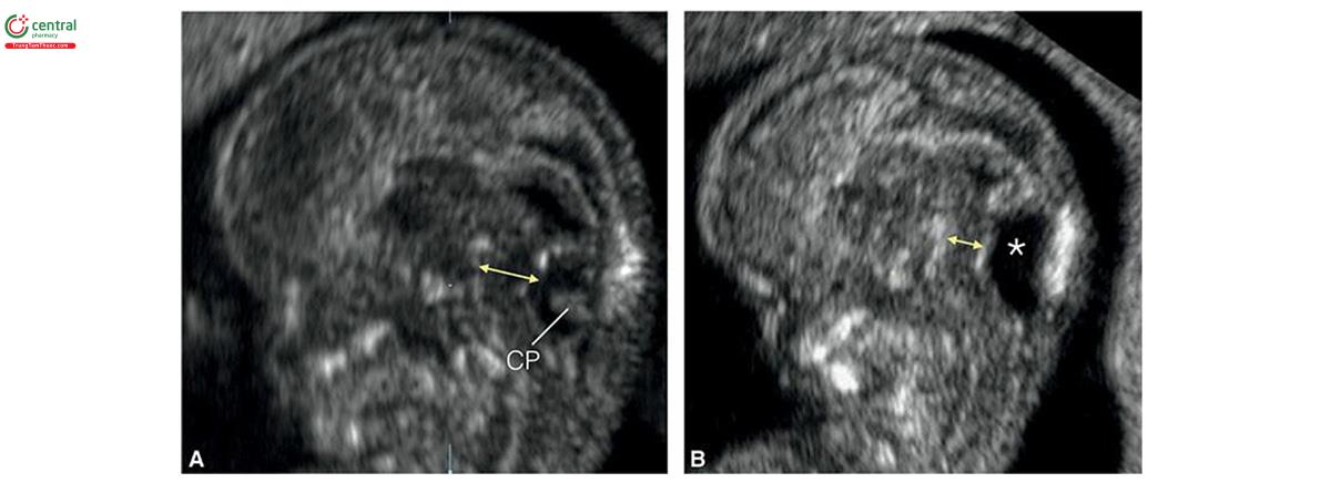 Hình 8.48: Mặt cắt dọc giữa đầu lúc 12 tuần tuổi cho thấy hố sau ở thai nhi bình thường (A) và thai nhi bị dị tật Dandy-Walker (B). Lưu ý, ở thai nhi B, tăng lượng dịch não tủy (dấu hoa thị) ở hố sau mà không có đám rối mạch mạc (CP) khi so sánh với thai nhi A. Thân não (mũi tên hai đầu) cũng mỏng ở thai nhi bị dị tật Dandy- Walker.