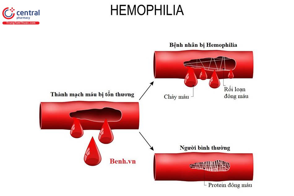 Bệnh ưa chảy máu Hemophilia
