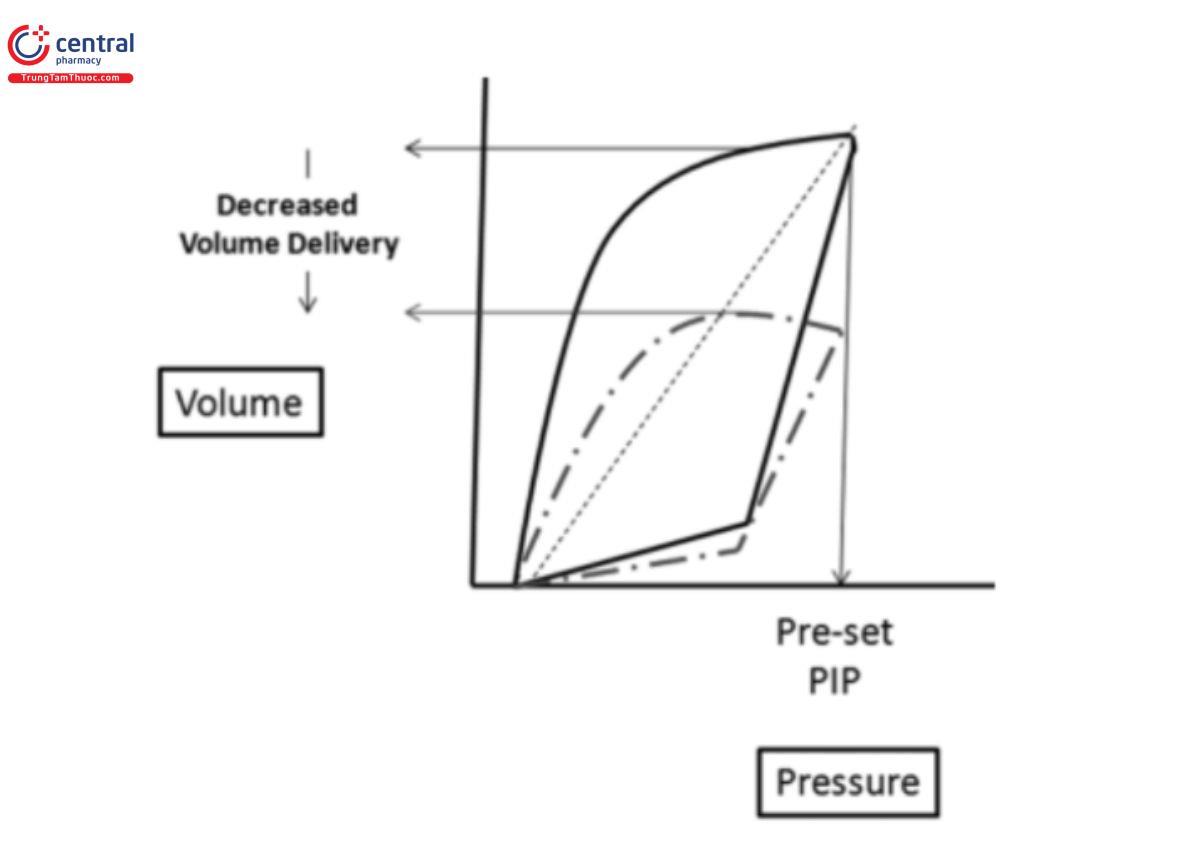 Hình 11: Vòng lặp PV trong quá trình thông khí nhắm mục tiêu áp lực. Áp lực được kiểm soát ở giá trị đặt trước. Với sự suy giảm độ giãn nở của phổi hoặc sức cản tăng lên, thể tích khí lưu thông giảm xuống và vòng lặp nghiêng xuống và sang phải.