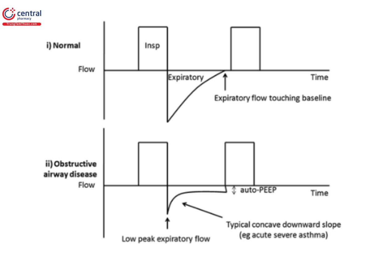 Hình 16: Dạng sóng lưu lượng-thời gian. i) Lưu lượng không đổi bình thường, ii) Bệnh tắc nghẽn đường thở, nổi bật là PEF thấp, độ lõm và PEEP nội sinh. 