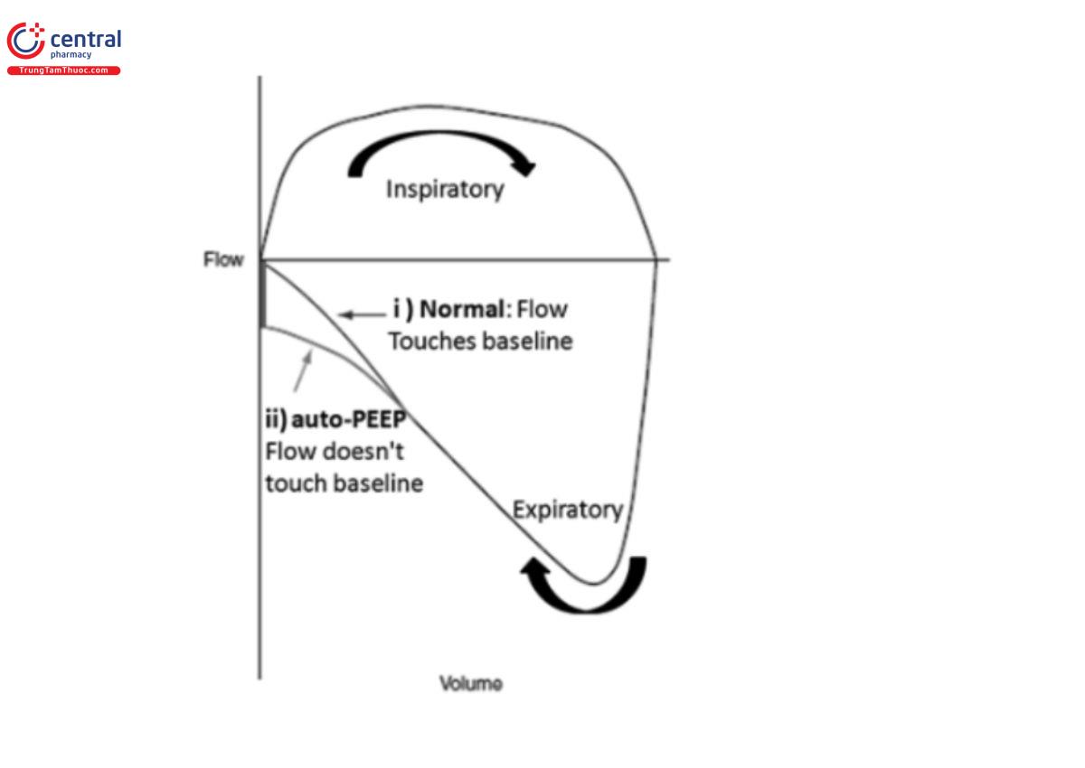 Hình 18: Vòng lặp lưu lượng-thể tích: i) bình thường và ii) auto – PEEP 