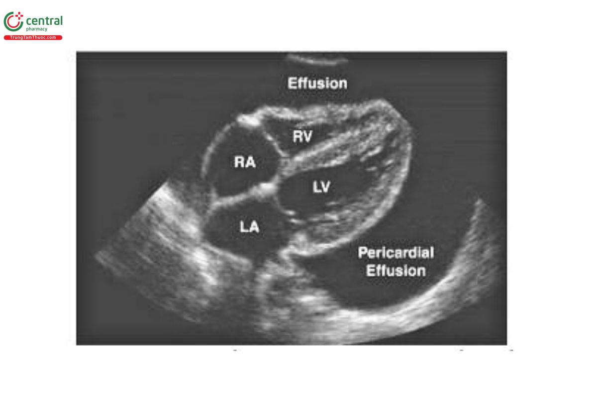 HÌNH 21.5 Hình ảnh siêu âm (góc dưới sườn) cho thấy tràn dịch màng ngoài tim lớn, xuất hiện dưới dạng một dải không phản âm rộng bao quanh tim. Hình ảnh được chỉnh sửa từ Trường Y khoa Stritch thuộc Đại học Loyola, chương trình giáo dục y khoa về X quang, tại www.stritch.luc.edu, truy cập ngày 18/11/2023.