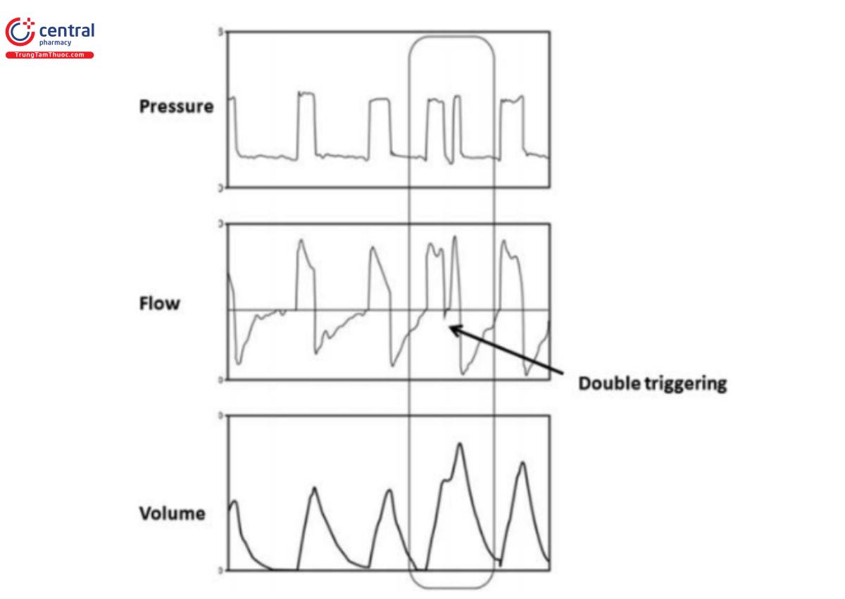 Hình 27: Một ví dụ về kích hoạt kép trong thông khí hỗ trợ áp lực. Nhu cầu của bệnh nhân tiếp tục vượt quá thời gian hít vào đã đặt, dẫn đến việc kích hoạt nhịp thở bắt buộc thứ hai trong cùng một nỗ lực của bệnh nhân.
