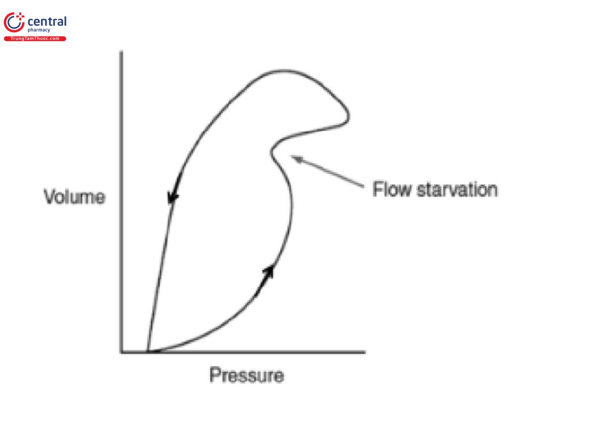 Hình 30: Vòng lặp áp lực-thể tích: thiếu lưu lượng. 