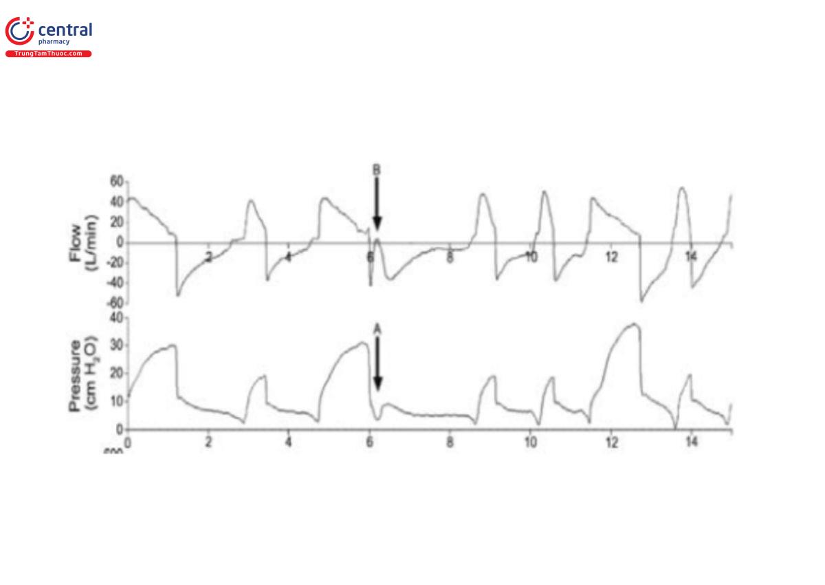 Hình 33: Chu kỳ sớm được coi là mức giảm âm dưới PEEP trên đường cong áp lực (A). Lưu lượng tăng đồng thời cũng được nhìn thấy (B) 