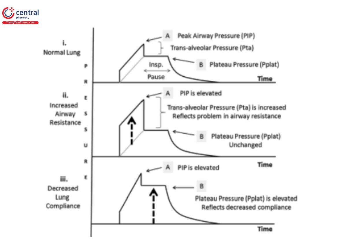 Hình 5: Dạng sóng áp lực-thời gian trong chế độ kiểm soát thể tích với lưu lượng không đổi và tạm dừng hít vào: i) phổi bình thường, ii) sức cản đường thở tăng, iii) độ giãn nở giảm. 
