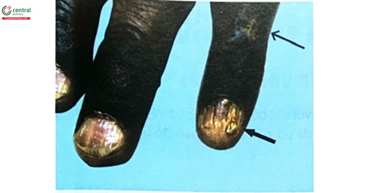 Hình 6.18. Phụ nữ 58 tuổi mắc hội chứng Bazex, có mảng dày sừng trên khớp đốt ngón tay (mũi tên mỏng) và móng giòn, teo (mũi tên dày) (Nguồn: Jessica G. Zarzour, 2011, Journal of Radiology Case Reports)