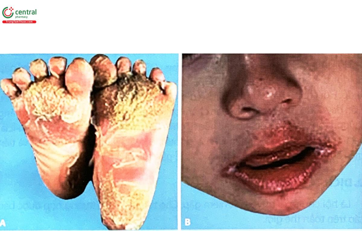 Hình 4.25A. Biểu hiện dày sừng bàn chân lan tỏa đối xứng  Hình 4.25B. Các mảng tăng sừng quanh miệng  (Nguồn: Megan Furniss, 2014, Journal of Investigative Dermatology)