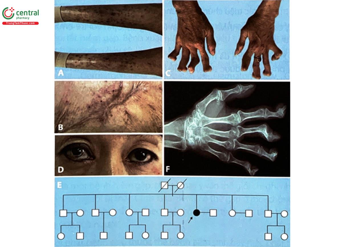 Hình 4.26. Bệnh nhân nữ gốc Hoa 49 tuổi, biểu hiện bệnh từ năm 12 tuổi với tổn thương da 37 năm và tổn thương khớp 31 năm  A. Mụn nước và sẹo ở chi dưới. B. Viêm da mủ hoại thư ở mông đã lành.  C. Biến dạng bàn tay. D. Tổn thương giác mạc có thể được quan sát khi khám thực thể.  E. Phả hệ của bệnh nhân. F. Chụp X-quang bàn tay cho thấy hình ảnh loãng xương, thu hẹp nhiều khe khớp, tăng sinh xương, bán trật và co rút (Nguồn: Marco Castori và cộng sự, 2014, Iranian Journal of Neurology)