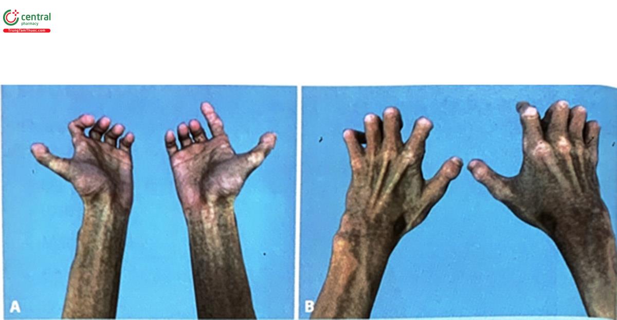 Hình 4.2. Bàn tay có biểu hiện da trông cứng khớp, giảm khả năng vận động và mắt lớp mỡ dưới da (A: tư thế ngửa) (B: tư thế sắp) (Nguồn: Natnicha Pongbangli và cộng sự)