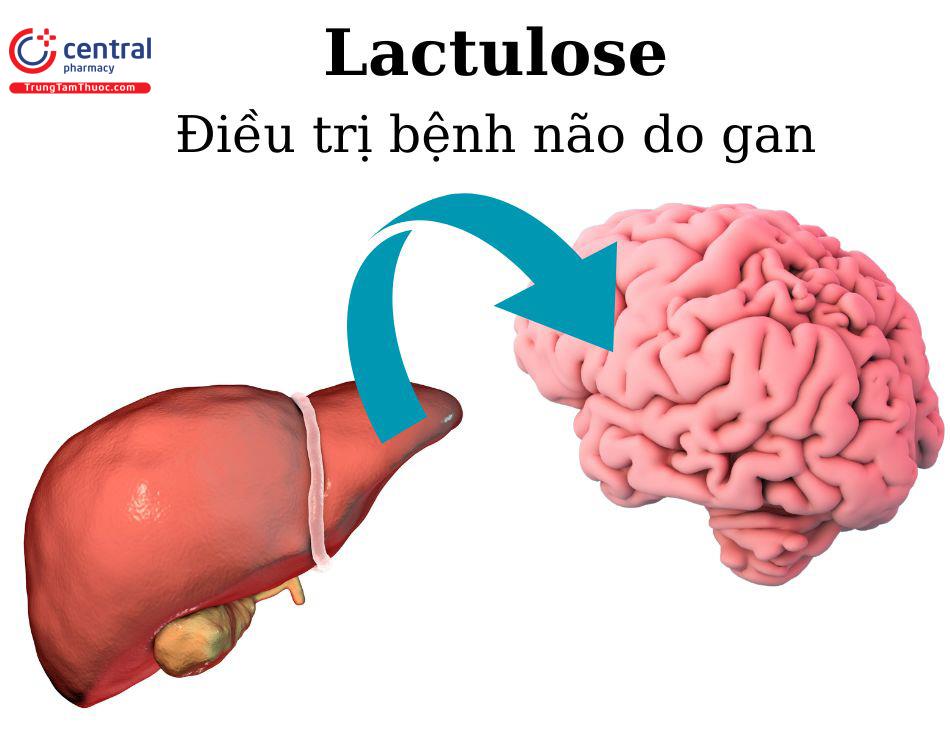 Điều trị bệnh não gan bằng Lactulose